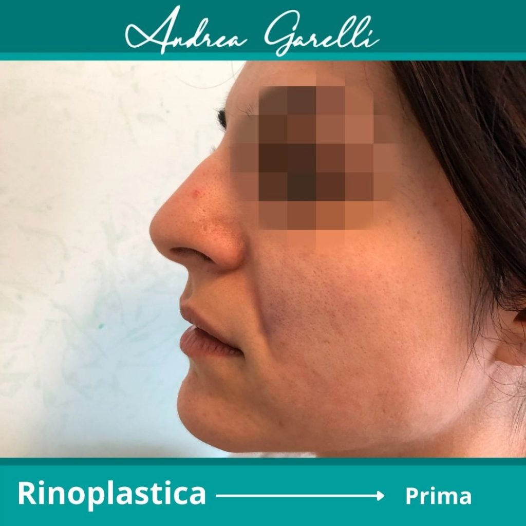 Rinoplastica Roma - Dott. A. Garelli Chirurgia Plastica Estetica e